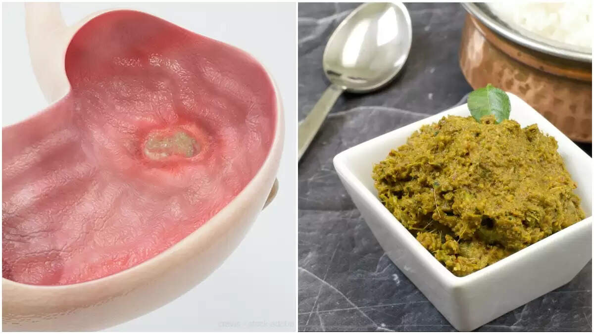 ஒரே வாரத்தில் அல்சர் குணமாக… இதை சாப்பிடுங்க!