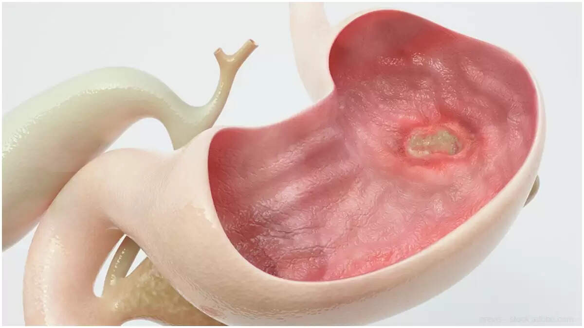 ஒரே வாரத்தில் அல்சர் குணமாக… இதை சாப்பிடுங்க!