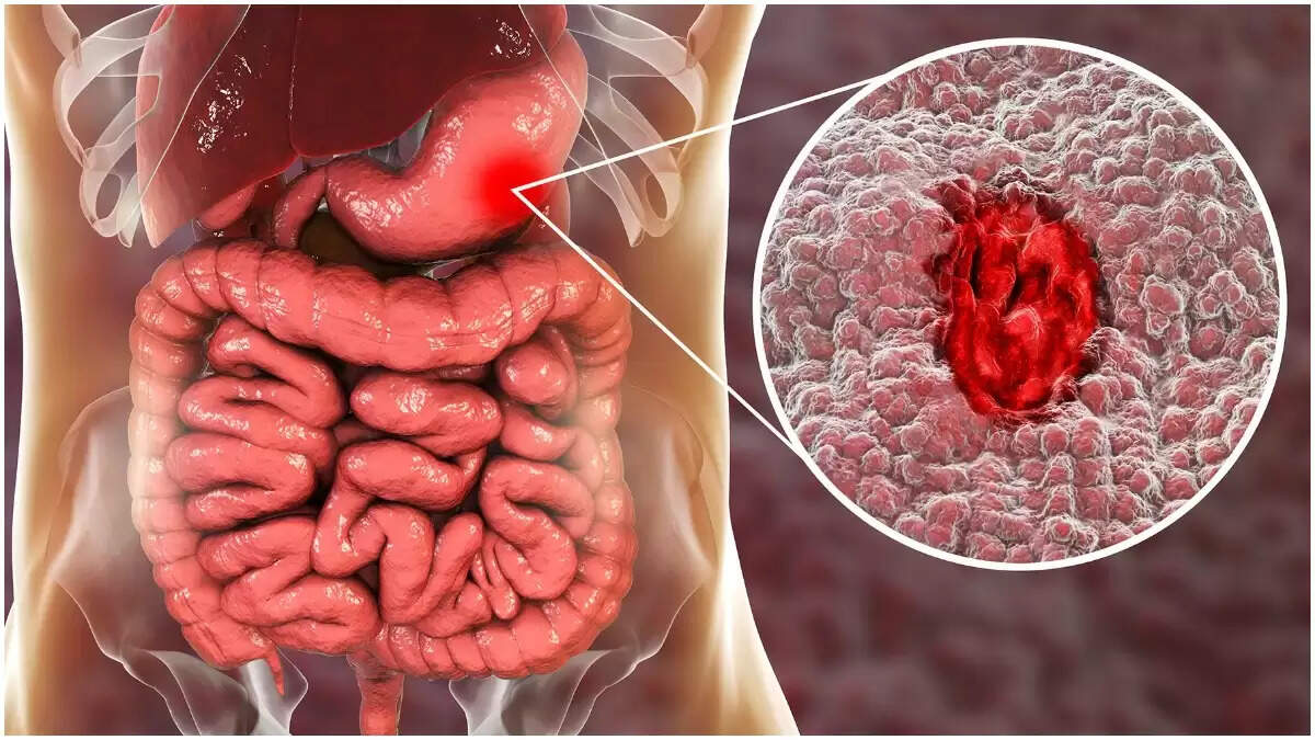 ஒரே வாரத்தில் அல்சர் குணமாக… இதை சாப்பிடுங்க!