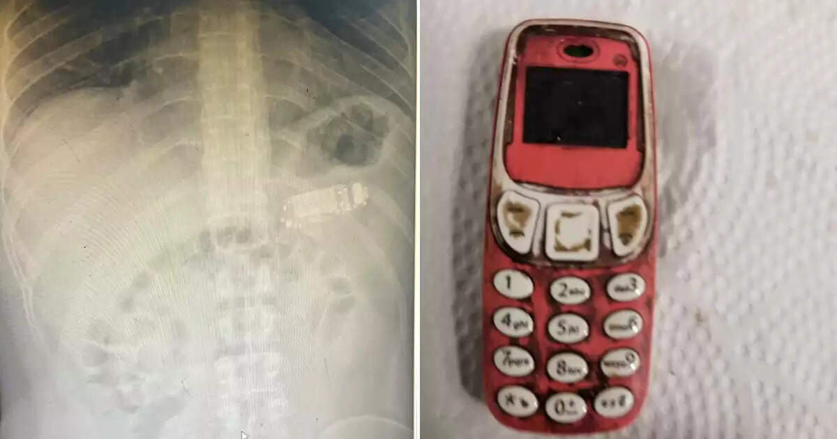 “சாப்பிடுறதுக்கு எதுவுமே கிடைக்கலயாபா” – செல்போனை விழுங்கிய இளைஞர்… ஷாக்கான மருத்துவர்கள்!