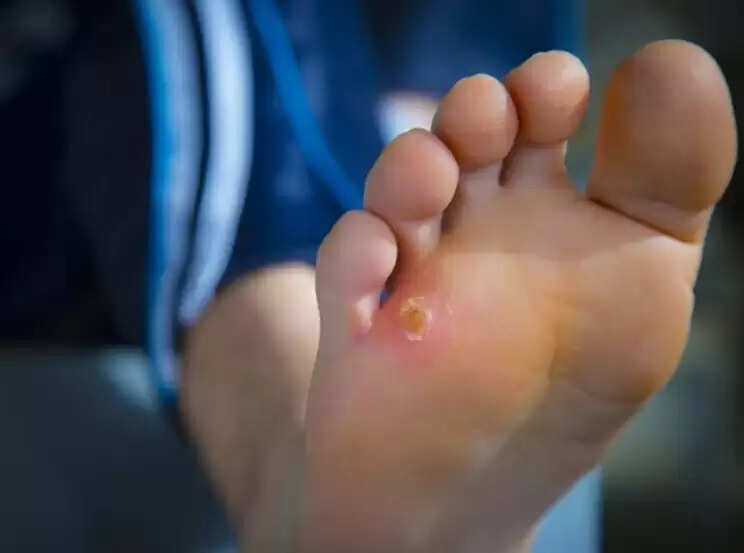 கால்ல இப்படி கொப்புளம் வந்தா ஒரே நாள்ல எப்படி சரி பண்ணலாம்?