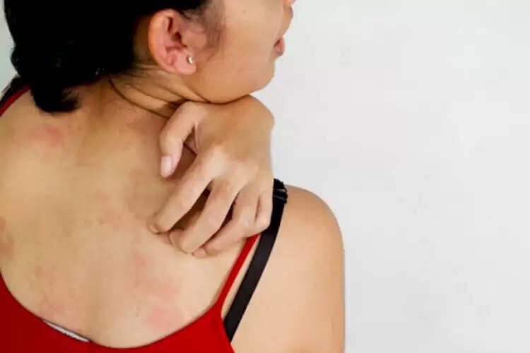 வியர்க்குருவுக்கு தீர்வு தருமா பவுடர்?