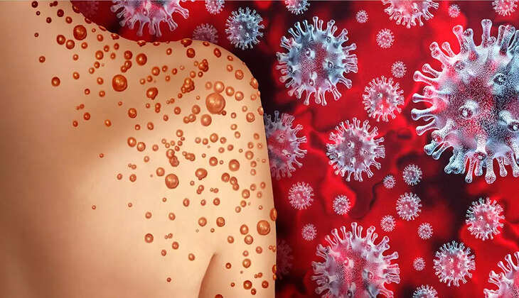 இந்தியாவில் நுழைந்த குரங்கு அம்மை.. அறிகுறியும்.. தீர்வும்..