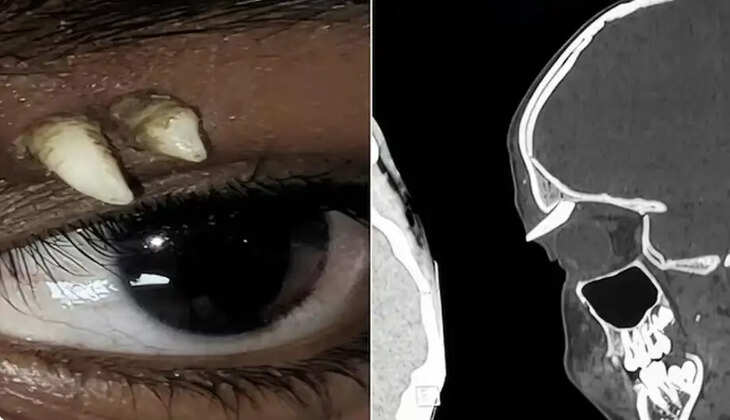 கண்ணுக்கு மேல் வளர்ந்த பல்! அவதிப்படும் 16 வயது சிறுவன்&nbsp;