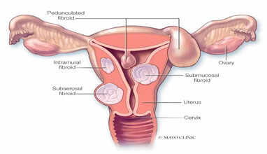 fibroid