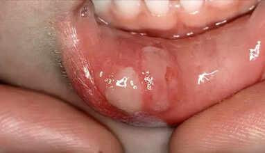mouth ulcer