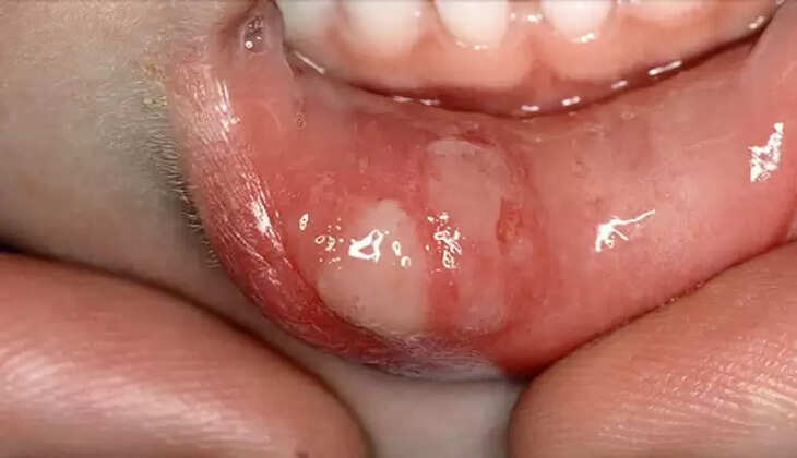 mouth ulcer