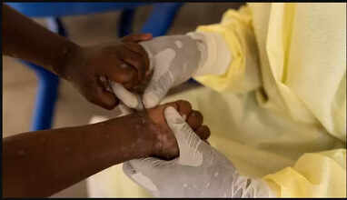 இந்தியாவில் குரங்கம்மை பாதிப்பு இல்லை..  ஆனால்..!! உடனே இதை செய்ய வேண்டும் - ஒன்றிய சுகாதாரத்துறை அறிவுறுத்தல்.. 