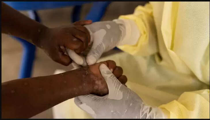 இந்தியாவில் குரங்கம்மை பாதிப்பு இல்லை..&nbsp; ஆனால்..!! உடனே இதை செய்ய வேண்டும் - ஒன்றிய சுகாதாரத்துறை அறிவுறுத்தல்..&nbsp;