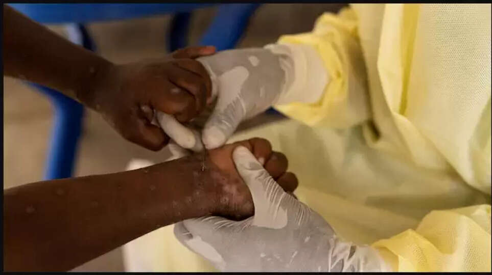 இந்தியாவில் குரங்கம்மை பாதிப்பு இல்லை..  ஆனால்..!! உடனே இதை செய்ய வேண்டும் - ஒன்றிய சுகாதாரத்துறை அறிவுறுத்தல்.. 