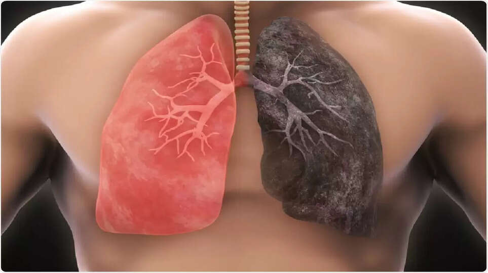 Lung Cancer