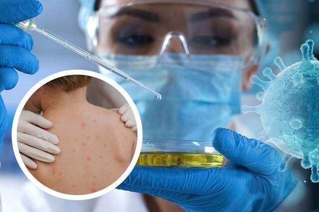 குரங்கம்மை பரவல் அதிகரிப்பு - அமெரிக்காவில் சுகாதார அவசர நிலை பிரகடனம்