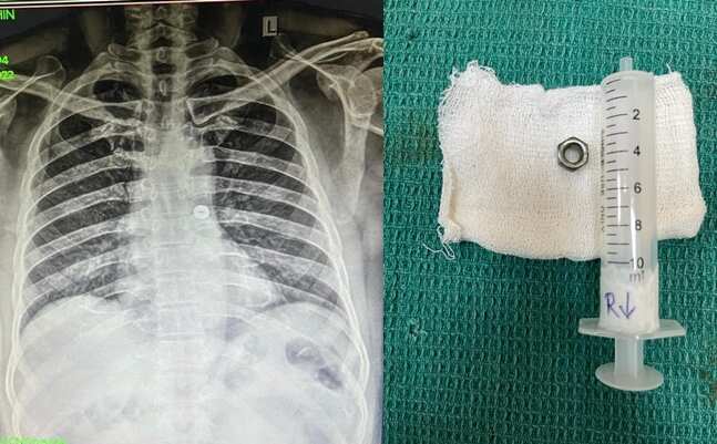 தவறுதலாக போல்ட் நட்டை விழுங்கிய எலக்ட்ரீசியன்... அறுவை சிகிச்சை மூலம் அகற்றிய கோவை அரசு மருத்துவர்கள்!