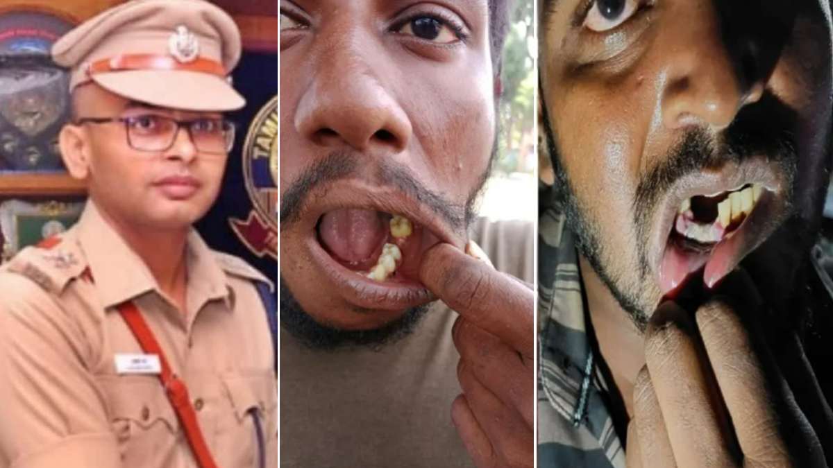 பற்களை பிடுங்கிய விவகாரத்தில் காத்திருப்போர் பட்டியலில் இருந்தோருக்கு மீண்டும் பணி