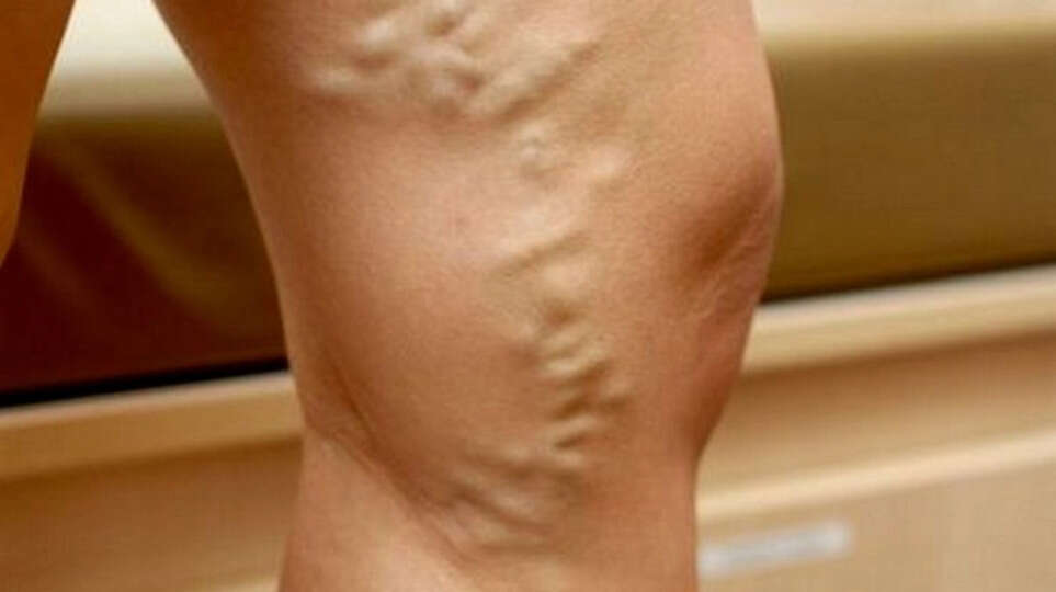 verikos vein