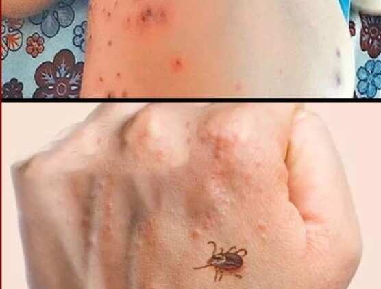 தமிழகத்தில் அதிகரிக்கும் ‘ஸ்கரப் டைபஸ்’ தொற்று! எச்சரிக்கும் மருத்துவர்கள்