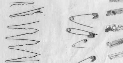 வயிற்றுக்குளே 13 ஹேர்பின் உள்ளிட்ட கூர்மையான பொருட்கள் - சாதுர்யமாக அகற்றிய மருத்துவர்கள்