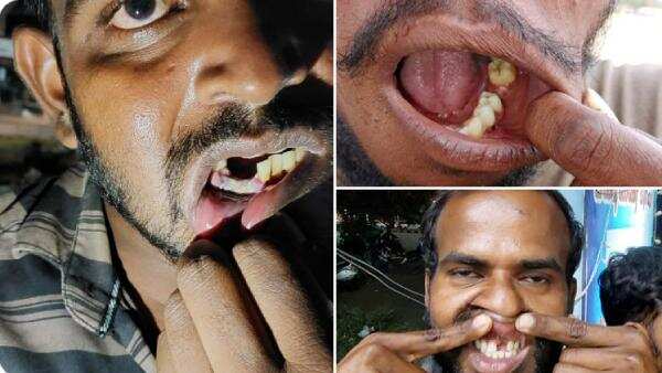 பல்லை பிடுங்கிய விவகாரம்- பாதிக்கப்பட்ட 3 பேருக்கு சம்மன்